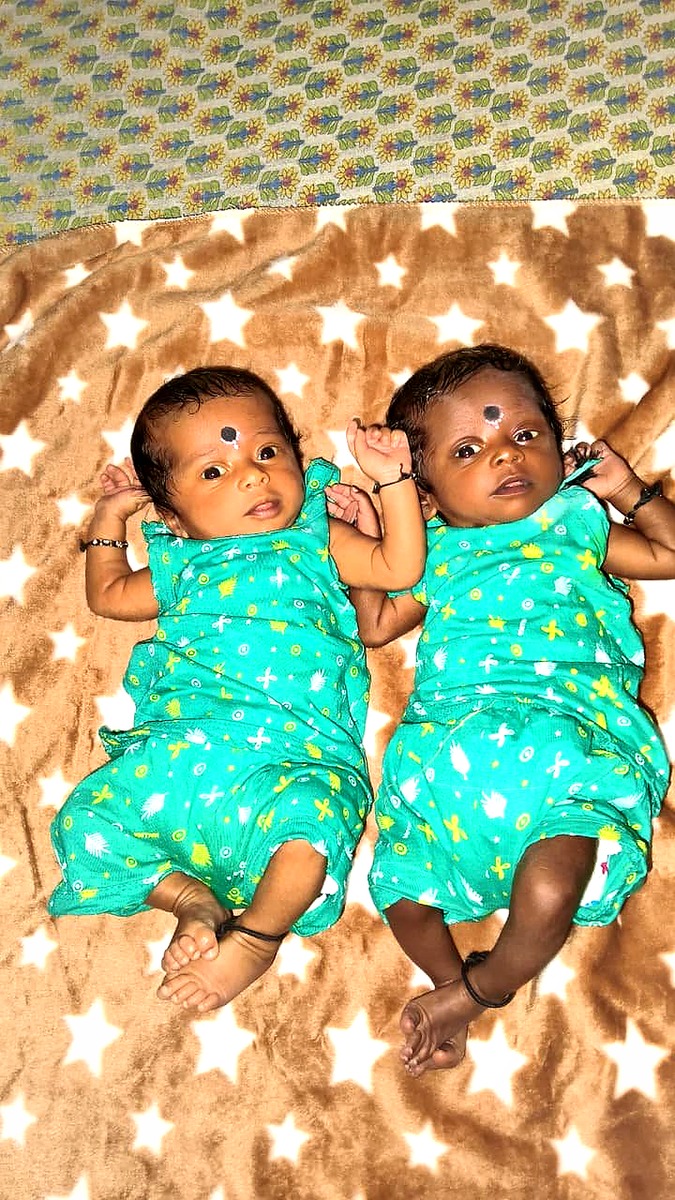 IVF twins Hyderabad Mother Hospitals